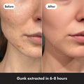 Before and after comparison of a person's face with acne, showing gunk extracted in 6-8 hours.