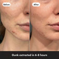 Before and after comparison of a person's face with acne, showing gunk extracted in 6-8 hours.