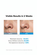 Before and after comparison of skin with blackheads, excess oil, and pore appearance reduction.