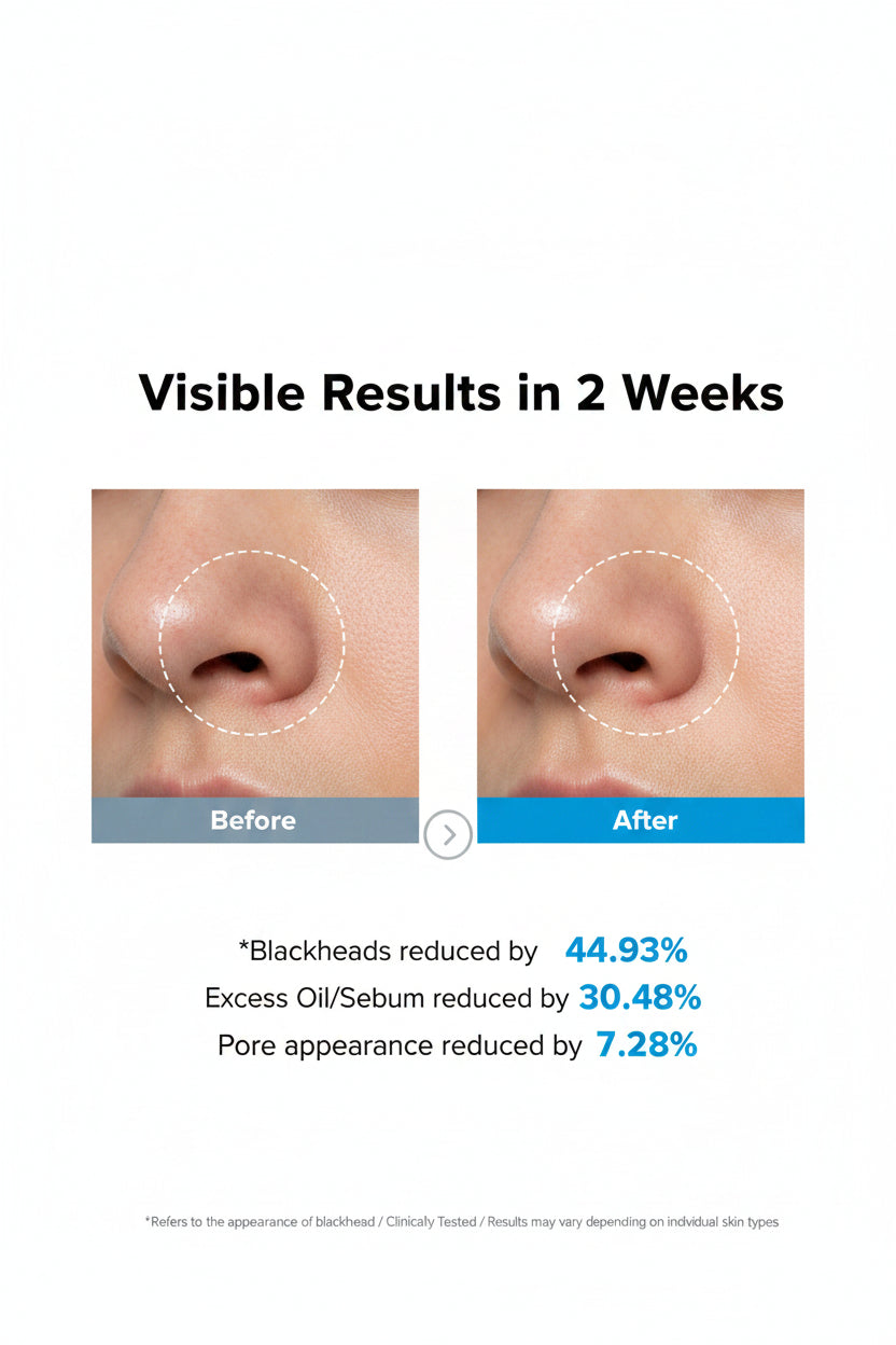 Before and after comparison of skin with blackheads, excess oil, and pore appearance reduction.