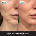 Before and after comparison of a person's lower face showing acne and blemishes on the jawline and chin, with dotted circles highlighting the skin area. Text at the bottom reads 'Gunk absorbed in 6-8 hours'.