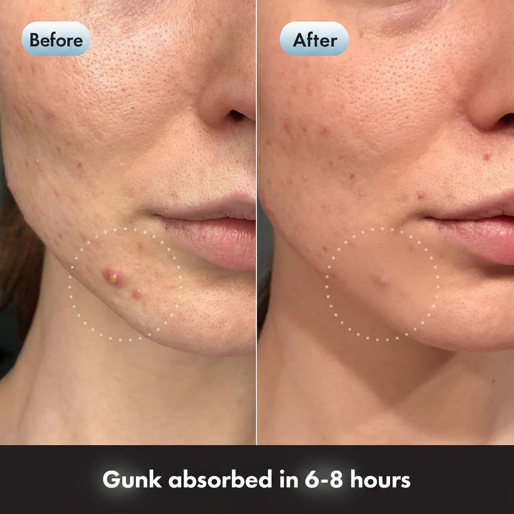 Before and after comparison of a person's lower face showing acne and blemishes on the jawline and chin, with dotted circles highlighting the skin area. Text at the bottom reads 'Gunk absorbed in 6-8 hours'.