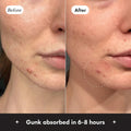 Before and after comparison of a person's face with acne, showing gunk extracted in 6-8 hours.