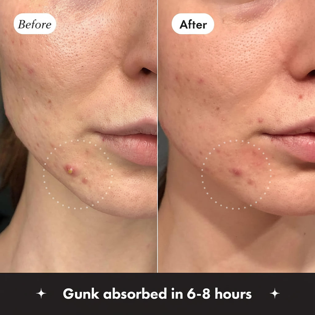 Before and after comparison of a person's face with acne, showing gunk extracted in 6-8 hours.