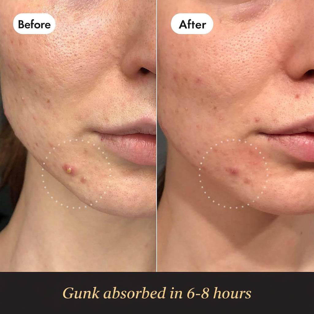 Before and after comparison of a person's face with acne, showing gunk extracted in 6-8 hours.