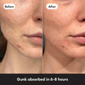 Before and after comparison of a person's face with acne, showing gunk extracted in 6-8 hours.