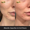 Before and after comparison of a person's face with acne, showing skin absorption of impurities.