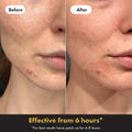 Before and after comparison of a skin treatment patch on a person's face.